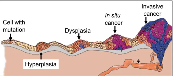Figure  1.1.1.  Cancer  development  starts  with  a  single  mutated  cell  and  progresses  with  the  accumulation  of  more  several  mutations  followed  by  changes  in  gene  expression