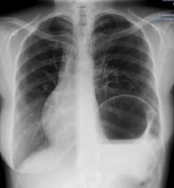 Figure 2. The cardiac shit was observed to retreat, but the diaphragmatic eleva- eleva-tion remained ater birth.