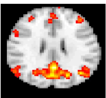 Figure 8 shows a slice of the default brain network obtained by the above fastICA algorithm thresholded and overlaid on a template brain.