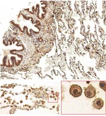Figure 3. GSNOR is present in normal lung tissue. Normal human lung tissue microarrays were stained with N30-C3 monoclonal GSNOR antibody (1 mg/mL) followed by DAB detection