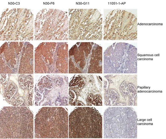 Table 1. Quantitation of GSNOR positive lung cancer tissue sections.