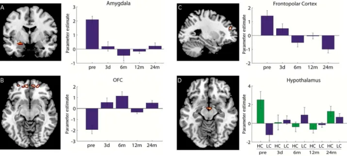 Figure 2. Imaging data. A left: Coronal view of amygdala activation for interaction food (F) vs