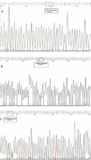 Figure 1. Sequencing data of complement factor H gene mutations  of patient. A) Homozygous p.His402Tyr mutation