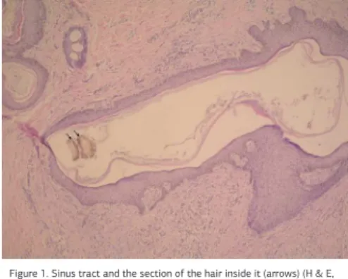Figure 1. Sinus tract and the section of the hair inside it (arrows) (H &amp; E,  original magniication, 10x20).
