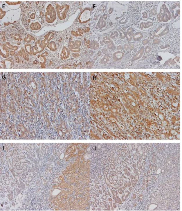 Figura 11. Galectina-3 e o receptor Notch-1 encontram-se inversamente correlacionados em tecidos tumorais  gástricos