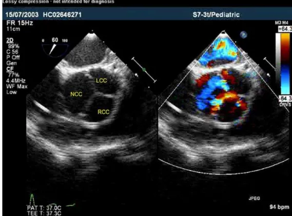 Figure 1. Short axis view of the aortic valve showing the dilated non coronary cusp (NCC), the right coronary cusp (RCC) and the left coronary cusp (LCC).