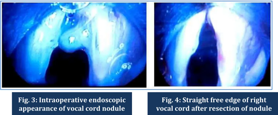 Fig. 3: Intraoperative endoscopic  appearance of vocal cord nodule