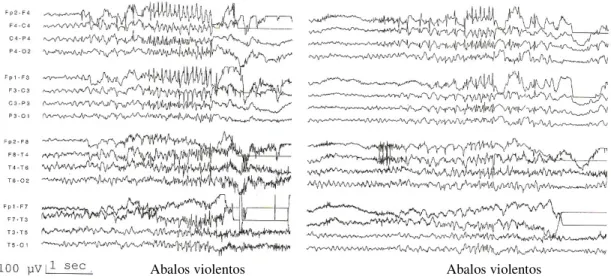 Figura  4.1.  Electroencefalograma  de  doente  do  sexo  feminino,  33  anos,  com  Epilepsia  Mioclónica  Juvenil