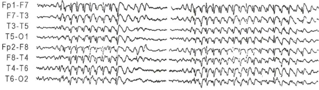 Figura 4.2.  Electroencefalograma  de  doente  do  sexo  masculino, 17 anos, com Epilepsia  Mioclónica Juvenil