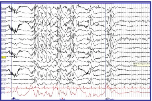 Figura 4.4.  EEG de doente do sexo feminino, 23 anos, com Epilepsia Mioclónica Juvenil