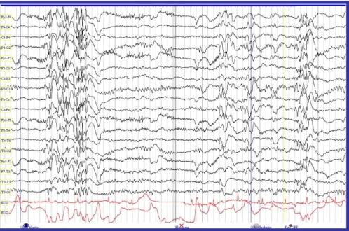 Figura  4.5.  EEG  da  doente  anterior,  com  descargas  poliponta-onda  durante  foto-estimulação,  com  olhos  abertos e fechados, e depois de cessar a estimulação