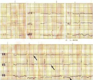 Figu ra  1.  Electrocardiogram a  en ritm o sinusal con on das T  con com ponente negativo de V 4 -V 6  (Flechas)