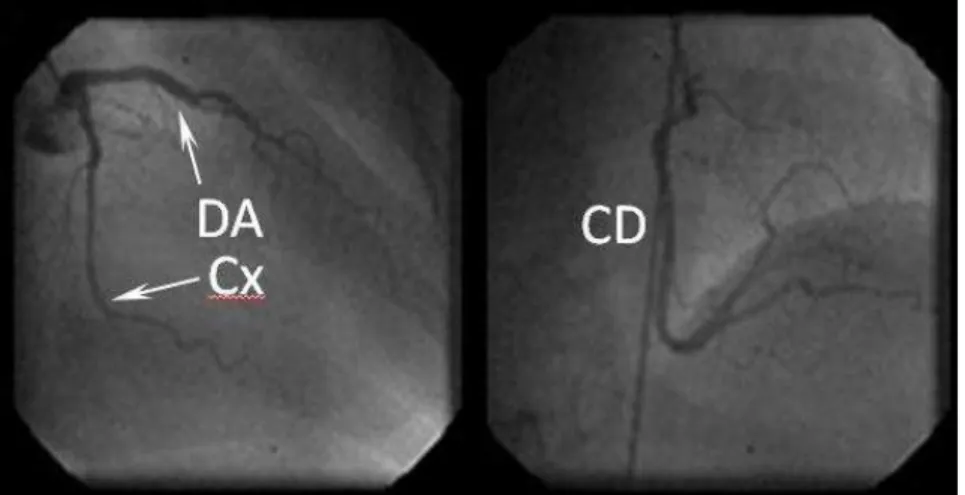 Figu ra 3 . Vistas angiográficas de las arterias cor onarias. DA, descen dente ante- ante-rior; Cx, circunfleja; CD, cor on aria derecha