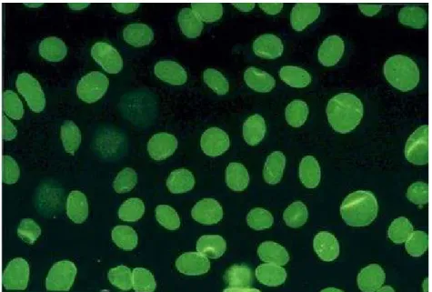 Figura  6 – Aspecto Homogéneo das células Hep-2 ( www.labodia.com/en7ana/Atlas/anaatlasnuclear.htm )  O  aspecto  mosqueado  (Figura  7)  tem  uma  interpretação  mais  complexa  e  está  correlacionado  com  anticorpos  contra  antigénios  extraídos  do  