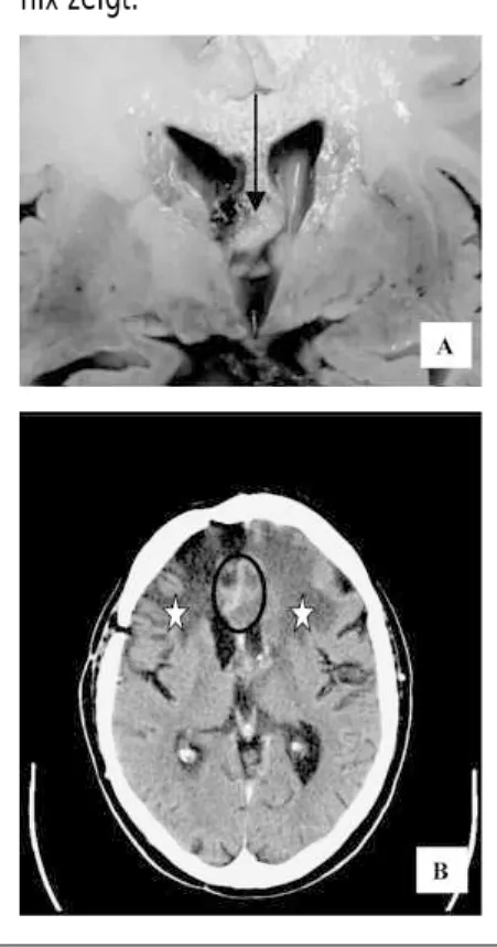 Abbildung 2:  A: Tumorrezidiv mit In- In-vasion des Fornix (Pfeil). B: CT mit Kontrastmittel, das eine  Leukenze-phalopathie frontal beidseits  (Ster-ne) nach Bestrahlung bei einem Tumorrezidiv mit Invasion des  For-nix zeigt.THERAPEUTI-SCHE KONZEPTE BEI P