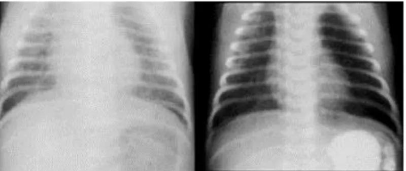 Figura  1  –  Imagem  radiográfica  de  um  mesmo  pulmão  com  diagnóstico  de  TTRN    6  horas após o nascimento e 24 após o nascimento