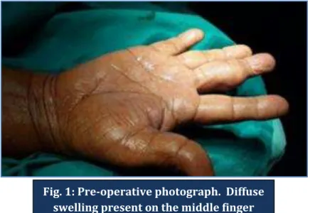 Fig. 1: Pre-operative photograph.  Diffuse   swelling present on the middle finger 