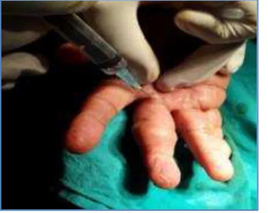 Fig. 3: A deeper dissection was made to assess  the basal attachment of the mass 