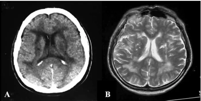 Figure 1. A) Brain computed tomography, confluent ischemic lesions in white matter and lacunar infarcts