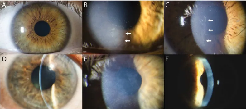 Fig 2. Clinical features of chromosome 10q23-q24 linked dystrophy. A. Affected individual V-2 (28 years old) demonstrates a clear cornea in the right eye
