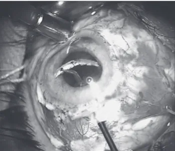 Figure 4. Extraction of intraocular foreign body during pars plana  vitrectomy with intravitreal forceps