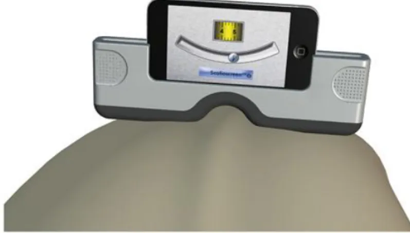 Figura 3.- Demonstração da combinação Scolioscreen – smartphone posicionado no dorso de um  paciente a realizar o teste de Adams