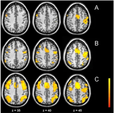 Figure 1. fMRI main effects. Group activation map over all subjects for the three different tasks alertness (A), 0-back (B), and 2-back (C) (Z.3.3, corrected p,0.01)