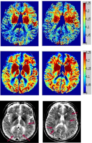 Figure 9. MWF maps of MS patient using conventional and spatially constrained method. MWF maps computed from in vivo MS patient scan