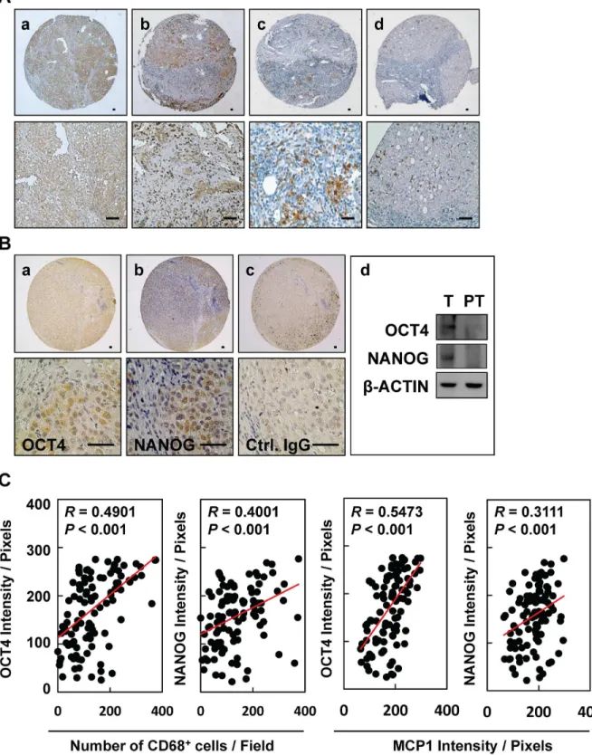 Fig 1. Expression of MCP-1/CD68 and pluripotent transcription factors OCT4 and NANOG in HBV-HCC tissues