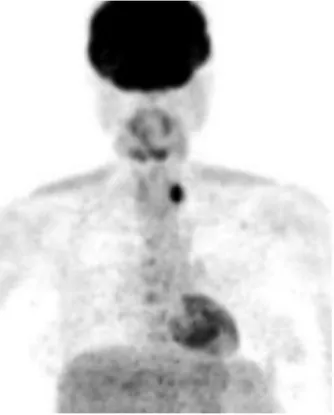 Şekil 1. Hastanın 18FDG-PET görüntüsünde sol tiroid lo- lo-bunda fokal artmış 18FDG tutulumu