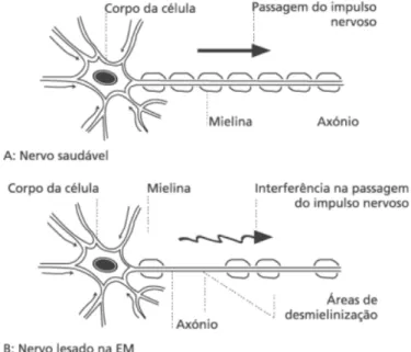 Figura 8 - Comparação entre uma célula nervosa saudável e uma lesada na EM. Adaptado de SPEM  (2010)