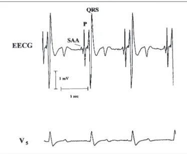 Abbildung 1:  Darstellung einer Sequenz von unauffälligen Schlägen im Oberflächen-EKG (V5, unten) im Vergleich zum Ösophagus-EKG (EECG, oben) während eines normalen Sinusrhythmus