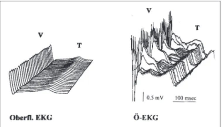 Abbildung 4:  Darstellung der ST-Strecken in einer ischämischen Episode im Oberflächen-EKG und gleichzeitig inhomogener ST-Strecken in einer ischämischen Episode im EKG