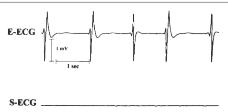 Abbildung 5:  Darstellung atrialer elektrischer Aktivitäten (P-Komponenten) im Ösophagus-EKG (E-ECG, oben) während des hypothermen,  Kalium-induzierten Herzstillstandes