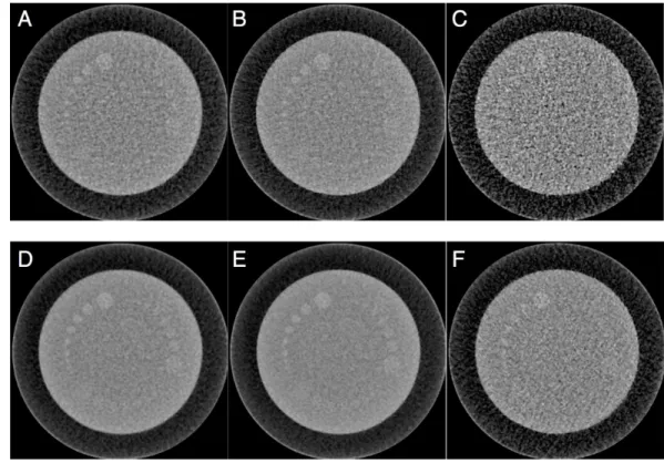 Figure 2 Reference and legato images. The original images obtained by filtered back projection (FBP) with reference dose (A), iterative reconstruction (IR) with reference dose (B), and IR with quarter  radi-ation dose (C) are shown in upper column