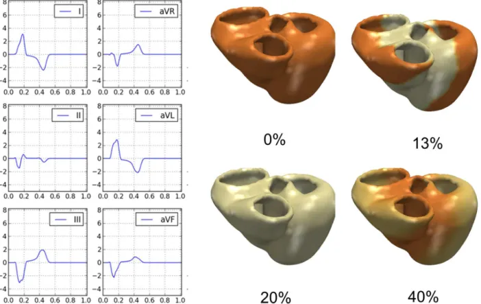 Fig 3. Patient-specific electrophysiology computation. Left Panels: Computed ECG traces from the model in the patient exemplarily chosen