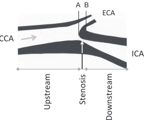 Fig 1. Description of a highly stenotic carotid plaque and the division of the endarerectomies