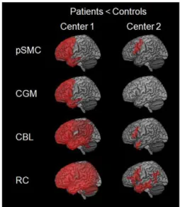 Figure 2. Regions showing a significant decrease in glucose metabolism in frontotemporal lobar degeneration compared to control subjects in center 1 (left) and 2 (right) after intensity normalization to different reference regions, in particular primary se
