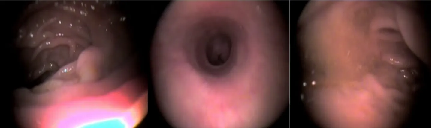 Figure 2. Endoscopy view of esophagus and duodenum without any pathologic finding 