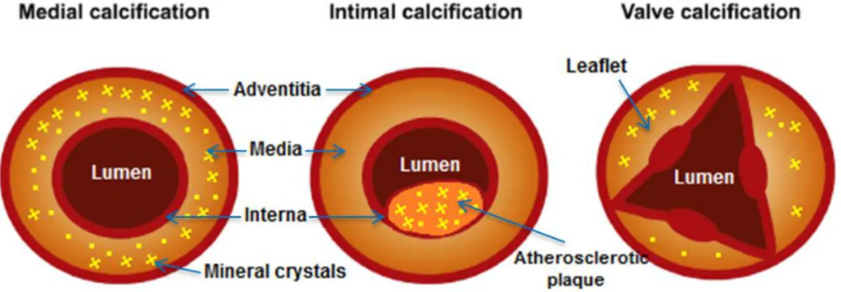 Figure  3.1 - Different types of vascular calcification. Vascular mineralization processes can   occur in adventitia, media and interna layers within that vascular wall