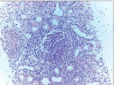 Figure 1:  Diffuse crescentic glomerulonephritis is shown h e original  magniication x200.