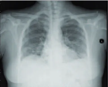 Figure 5 : Multiple caviter lesions in lung on high resolution ct hrct.
