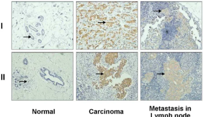 Figure 2. PKCf expressed strongly in carcinoma tissue, but weakly/not in normal tissue and in lymph node metastasis.