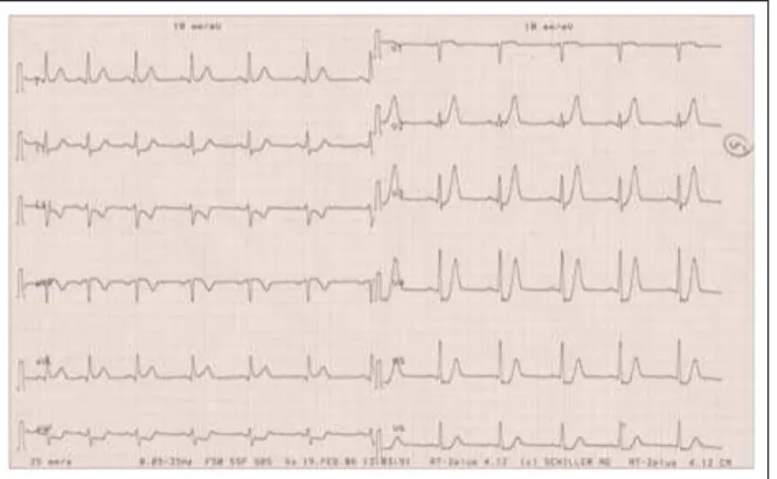 Abbildung 1:  Bei Aufnahme, mit thorakalem Druck: Sinusrhythmus, LT, f = 75/min, spitze hohe T-Wellen in den Brustwandableitungen, deszendierende  ST-Strecken-senkungen inferior.