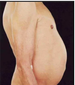 Figura 4. Hipertrofia da gordura abdominal. 