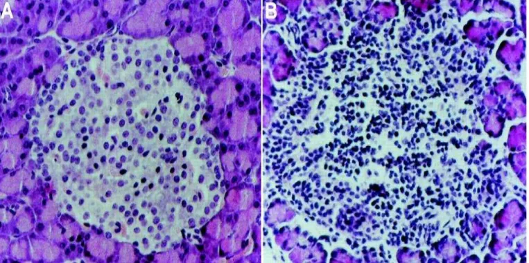 Figura 4  –  Micrografia de ilhotas pancreáticas (coloração HE). A - Ilhota normal. B - Ilhota com intensa infiltração  leucocitária (insulite)