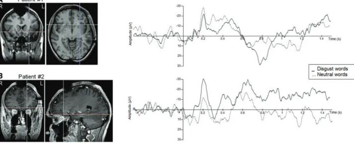 Fig. 4 sLORETA maps for the N400 component for the contrast between Disgust and Neutral (NoGo) words, centered on the maximum peak activity, in the left insula.