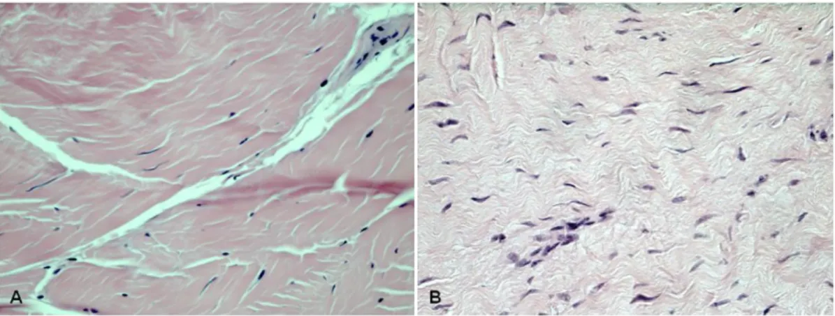 Figura 5.4. Coloração hematoxilina-eosina (ampliação 400x) de um indivíduo saudável  (A)  e  de  um  doente  com  patologia  degenerativa  (B)  onde  se  observa  diferenças  na  organização da matriz extracelular