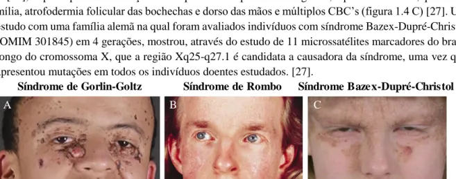 Figura 1.4. Composição de imagens reais representativas das principais síndromes hereditárias que têm como consequência  maioritária  o  aparecimento  de  múltiplos  CBCs  [22]