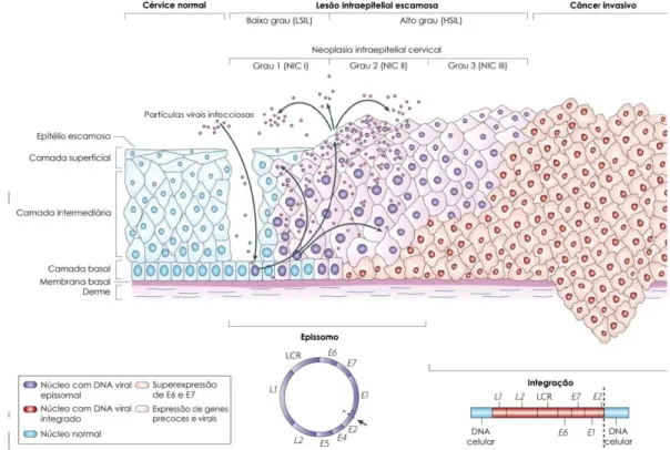 Figura 9.  Progressão das lesões do colo do útero.  As células da camada basal do epitélio cervical se  localizam sobre a membrana basal, que é sustentada pela derme